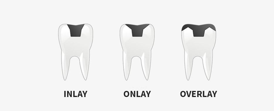 vemos dientes en distintas etapas de daño por caries